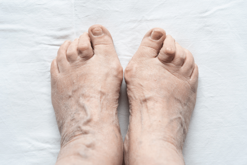Hammertoe Specialist in Illinois (1) Hammertoe Specialist in Illinois (1)
