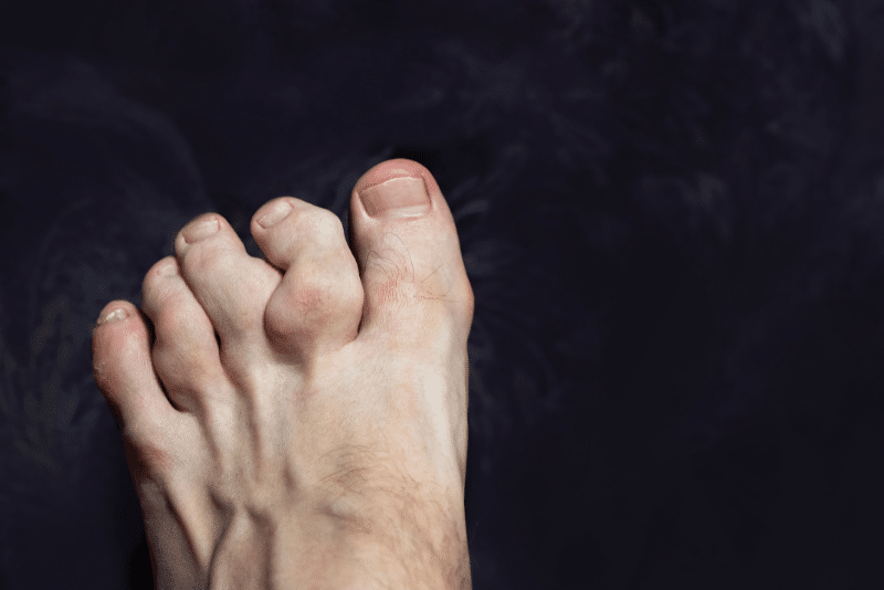 Hammertoe Specialist in Illinois (3) Hammertoe Specialist in Illinois