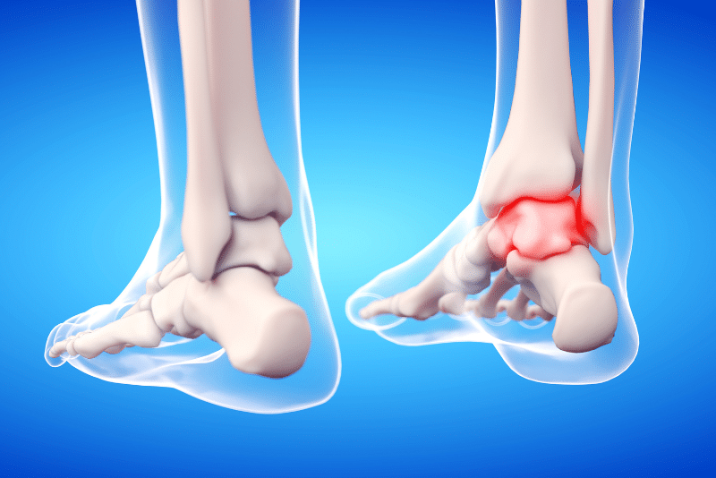 foot and ankle arthritis (1) foot and ankle arthritis