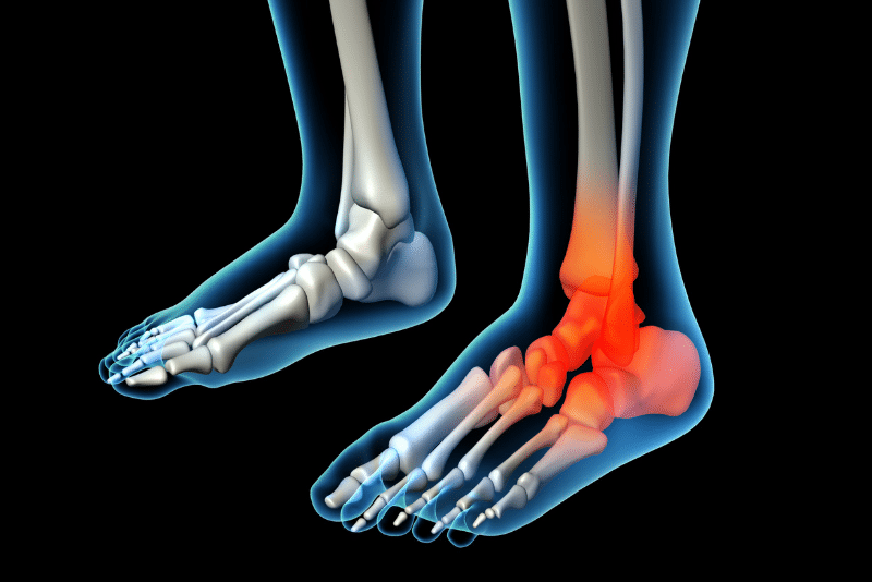 foot and ankle arthritis foot and ankle arthritis