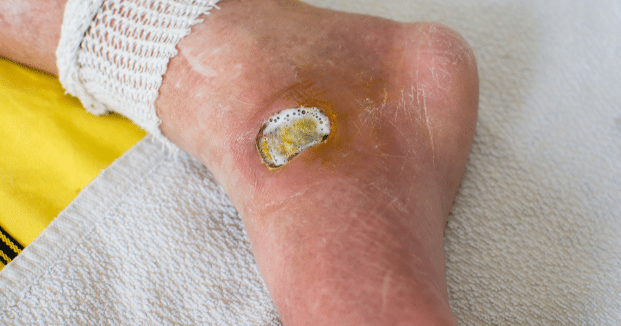 Diabetic Foot care (1) Diabetic Foot care