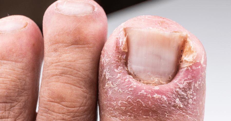 Ingrown Toenail Specialist in Illinois Ingrown Toenail Specialist in Illinois<br />